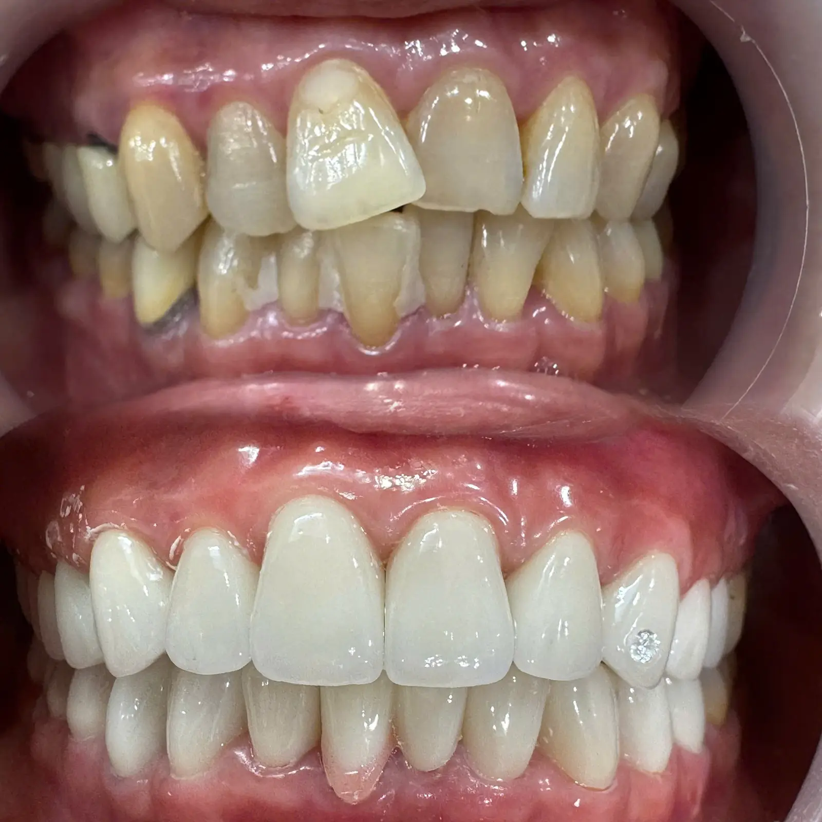 Răng Sứ Thẩm Mỹ